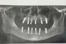 Pria di China Meninggal Dunia Usai Cabut 23 Gigi dalam Sehari, Berikut Penjelasan Dokter