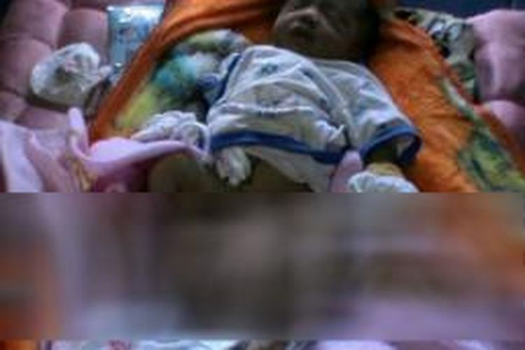Bayi berkepala dua lahir di Bengkulu. Satu kepala berada di antara selangkangan (foto diblur).