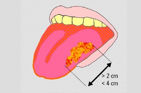 Ciri-ciri Kanker Lidah Stadium Awal