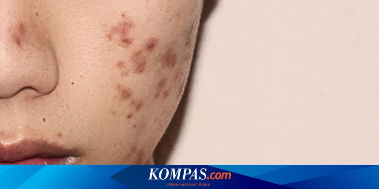 11 Perawatan Bekas Jerawat yang Ampuh Sesuai Jenisnya