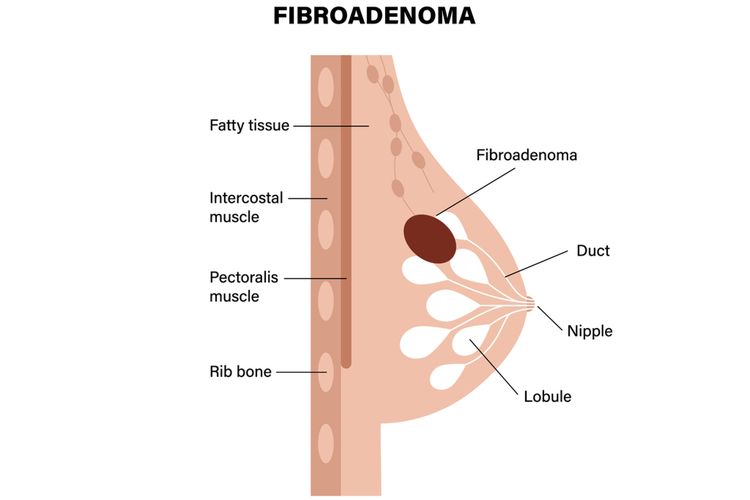 Ilustrasi Fibroadenoma