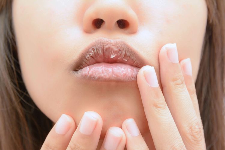 Ilustrasi bibir kering, penyebab bibir kering, kenapa bibir kering, cara mengatasi bibir kering. 