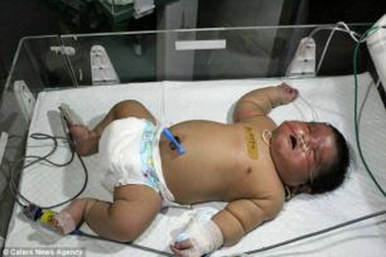 Bayi raksasa lahir di India dengan berat 6,7 kilogram.