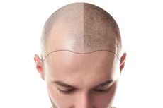 LG Ciptakan Helm Penumbuh Rambut untuk Atasi Kebotakan