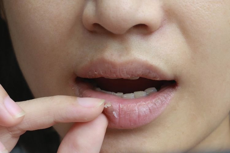 Menghindari kebiasaan mencungkil bibir adalah salah satu cara mengatasi bibir kering dan mengelupas saat puasa.