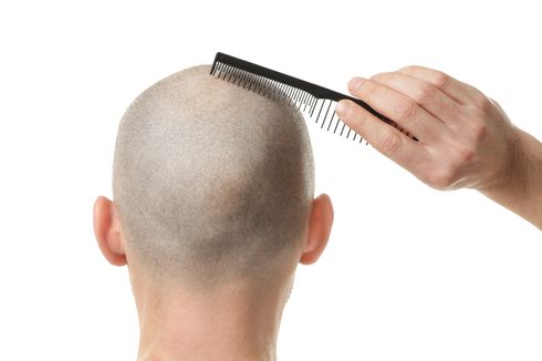7 Cara Menumbuhkan Rambut Botak dengan Cepat