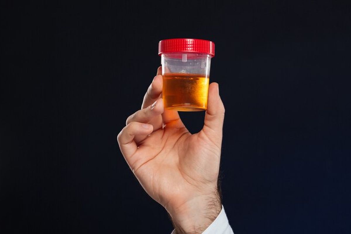 Ilustrasi sample urine. Warna urine bisa menjadi petunjuk penting dalam menilai kondisi kesehatan tubuh. 
