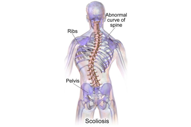 Ilustrasi tulang belakang yang mengalami skoliosis. Skoliosis menyebabkan tulang belakang melengkung ke kanan atau kiri. Derajat kelengkungan tulang belakang akan menentukan tingkat keparahan skoliosis.