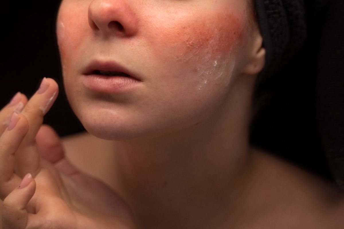 Ilustrasi rosacea.
