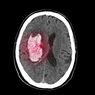 Apa Itu Pendarahan Otak? Ini Penyebab, Gejala dan Pengobatannya
