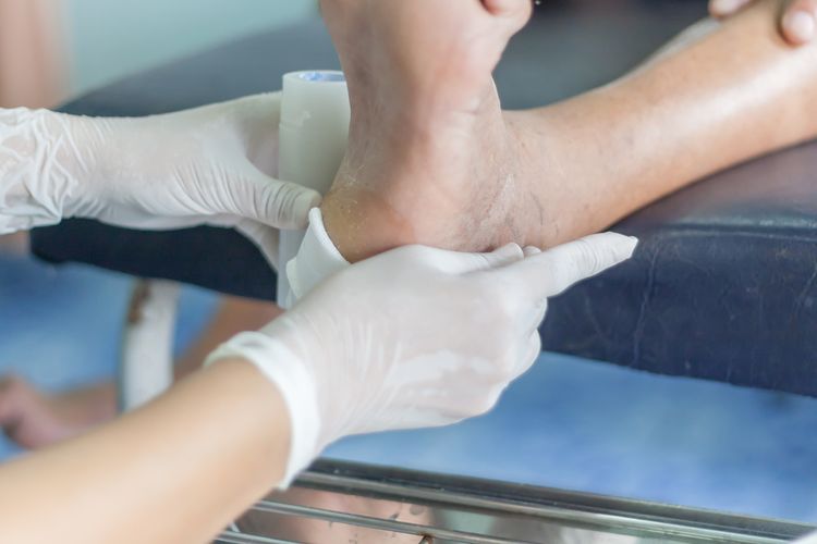 Ilustrasi luka di kaki penderita diabetes. Orang yang menderita diabetes 15 kali lebih mungkin menjalani amputasi dibandingkan orang lain yang tidak menderita penyakit ini. Sebab, mereka rentan mengalami luka parah tanpa disadari.