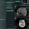 Teknologi Terkini Percepat Penanganan Pasien Stroke