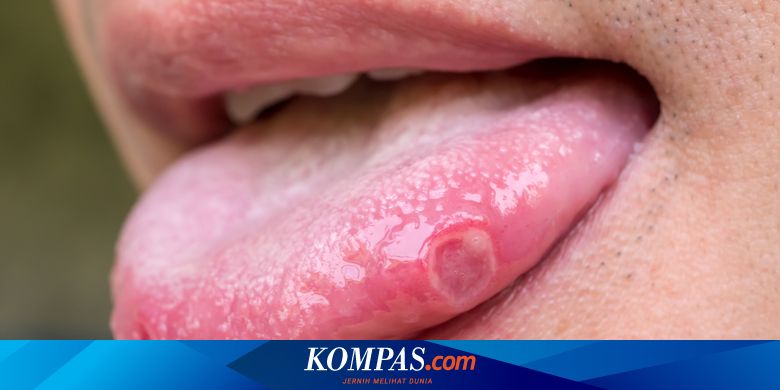 Sariawan di Lidah, Perlukah Diwaspadai?