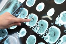 Prediksi Akurat Alzheimer dengan Tes Darah