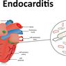 Endokarditis