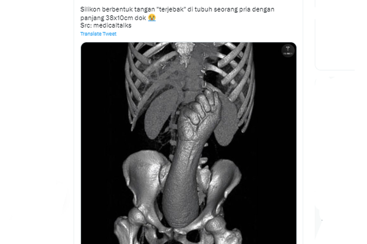 Tangkapan layar twit soal tangan silikon terjebak dalam tubuh