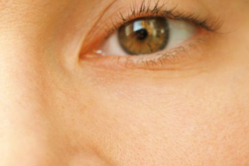 Floppy Eyelid Syndrome (FES)