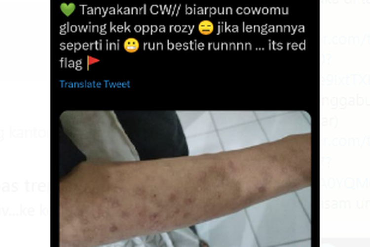 Tangkapan layar twit soal banyak bekas luka disebut gejala sifilis