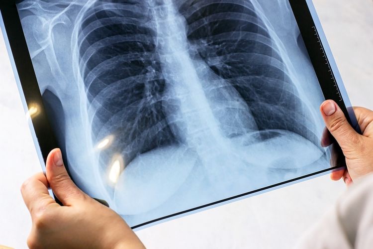Ilustrasi flek paru, ciri-ciri flek paru-paru, penyebab flek paru-paru, flek paru itu penyakit apa. 