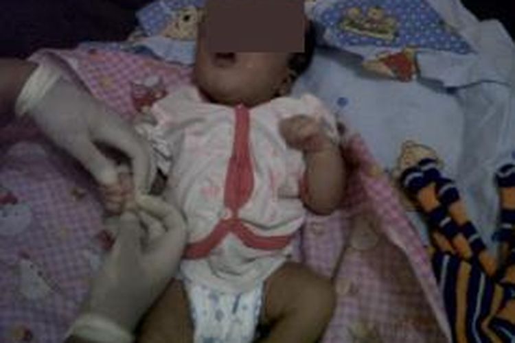 Seorang bayi perempuan bernama Rika Siti Salbiyah, terlahir ke dunia, Senin (9/6/2014) dengan kondisi tanpa tempurung kepala.