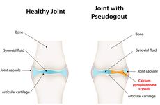 Waspada Pseudogout Mirip Asam Urat, Ini Gejala dan Cara Diagnosisnya