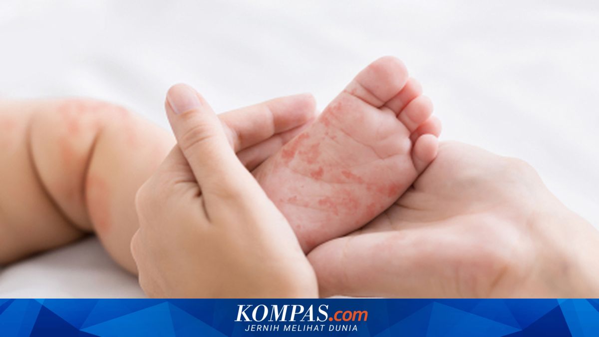 Kasus Campak RI Melonjak di Banyak Wilayah, Ini Daerah Paling Terdampak ~WR

Klik untuk baca: