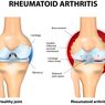 Rheumatoid Arthritis