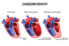 Kardiomiopati