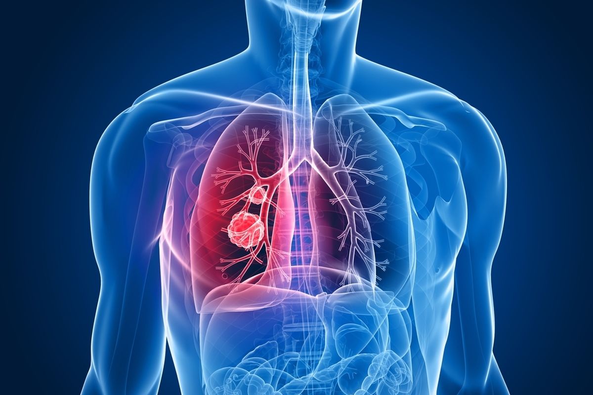 Kanker paru-paru dapat menyebabkan sejumlah komplikasi serius, meliputi dispnea, hemoptisis, kompresi sumsum tulang belakang, dan pneumonia. 