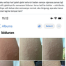 Ramai soal Kulit Badan Terasa Gatal dan Panas Mirip Biduran, Apa Penyebabnya?