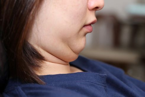 5 Penyebab Double Chin, Tak Hanya Kelebihan Berat Badan