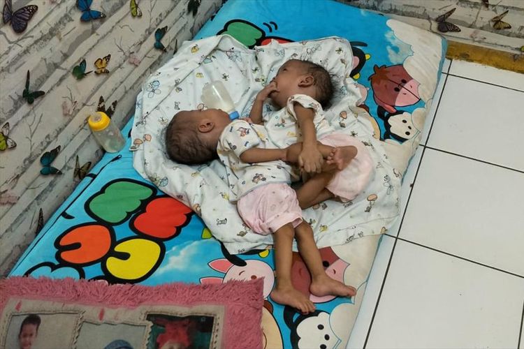 bayi kembar siam yang diberi nama Ahmad Rahman Al Ayyubi dan Ahmad Rahim Al Ayyubi di Kota Bekasi, Rabu (31/7/2019).
