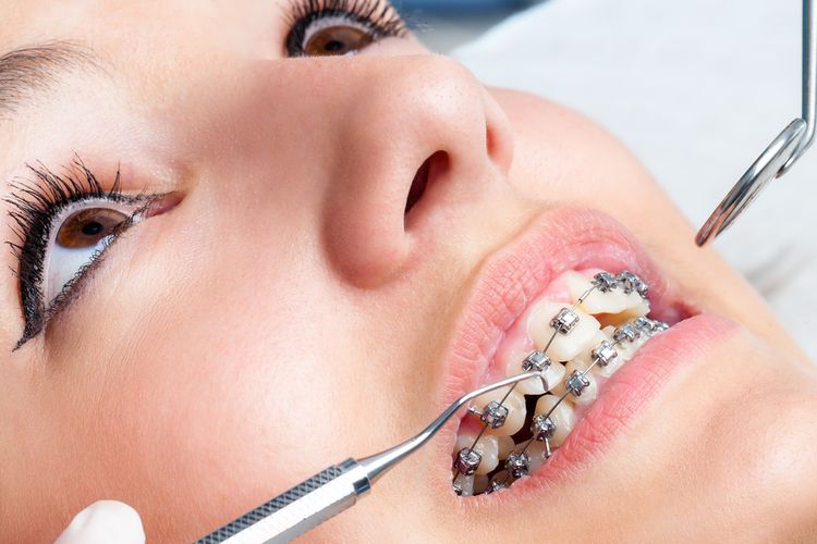 Jika memakai alat perawatan gigi, seperti kawat gigi atau bridge, membersihkannya secara menyeluruh sesuai arahan dokter gigi dapat menjadi cara menghilangkan bau mulut.