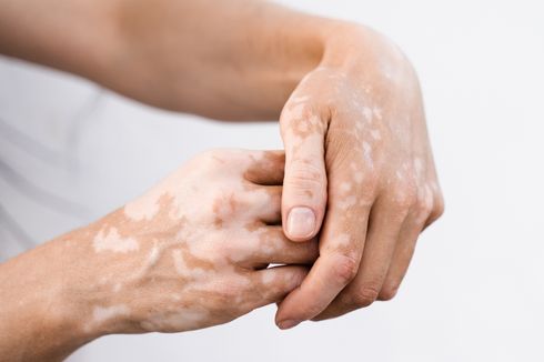 Studi Buktikan Stres Juga Bisa Memicu Vitiligo