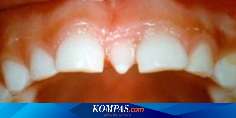 Tak Pede Karena Gigi Taring Muncul Di Tengah