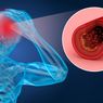 Penyebab Stroke Ringan yang Perlu Diwaspadai