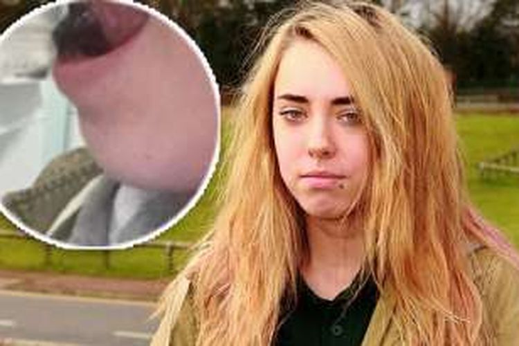 Amy Revell, 17, mengalami sesak napas dann benjolan di lidah setelah menindik lidahnya.