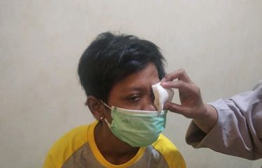 Manusia Silver Kehilangan Satu Matanya akibat Cat Semprot, Ahli ...
