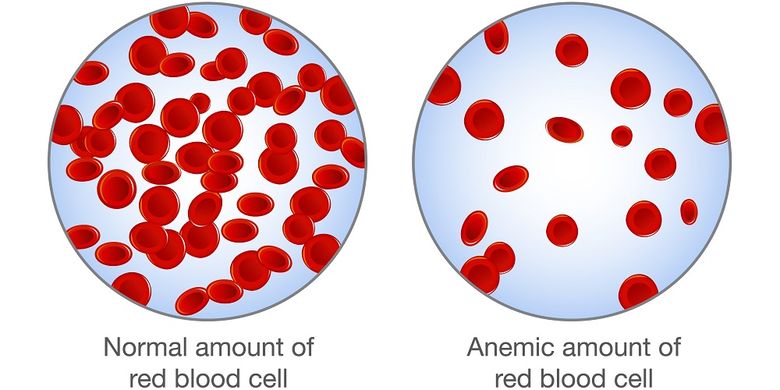 Ilustrasi sel darah merah normal dan anemia atau kekurangan sel darah merah.