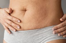 5 Penyebab Stretch Mark di Paha, Bisa karena Genetik