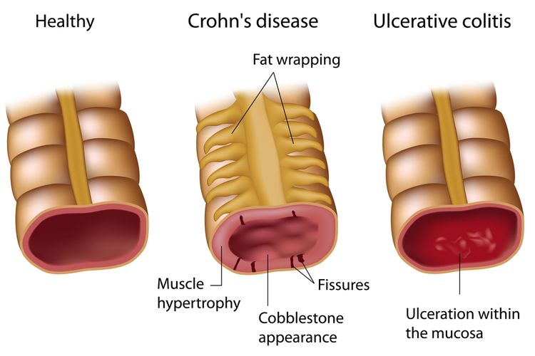 Penyakit autoimun radang usus (IBD) ini dibagi menjadi dua jenis, yaitu Penyakit Crohn (PC) dan Kolitis Ulseratif (KU).