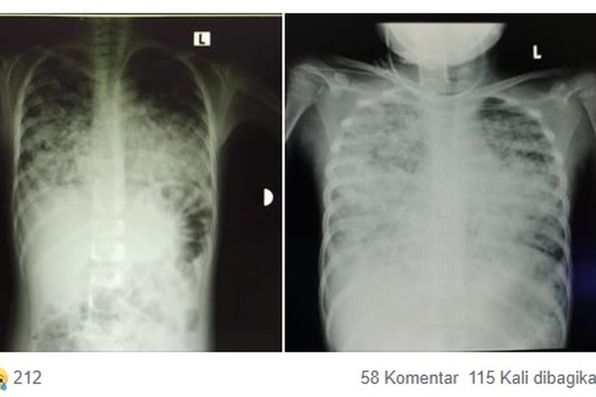 Tangkapan layar kondisi paru-paru milik seorang pasien anak berusia 7 tahun yang diduga positif terinfeksi virus corona. Perbandingan kedua foto paru kurang dari 24 jam infeksi semakin meluas telah terjadi pneumonia bilateral.