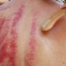  Mengenal Gua Sha, Kerokan Ala China untuk Mengatasi Berbagai Penyakit
