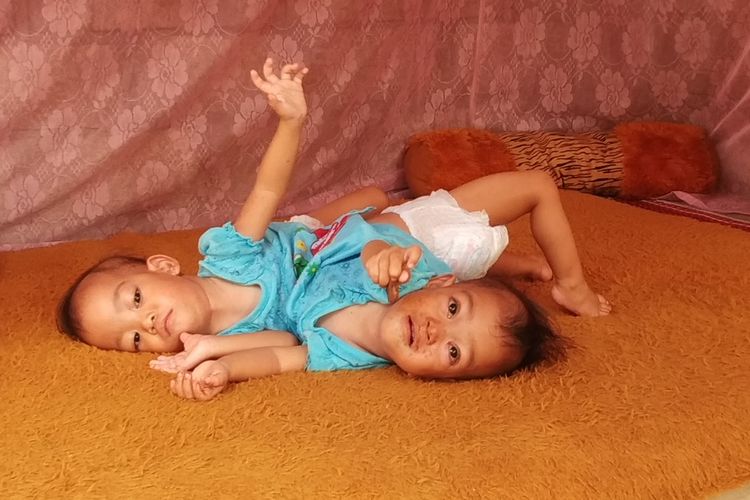 Bayi kembar siam Anaya dan Inaya saat tidur di Gazebo bersama ibunya
