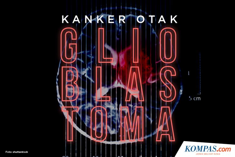 Kanker Otak Glioblastoma