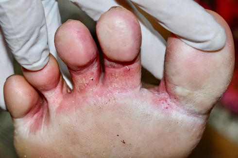 Kaki Atlet (Tinea Pedis)