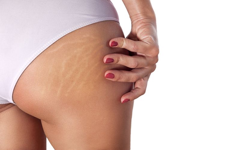 Ilustrasi stretch mark