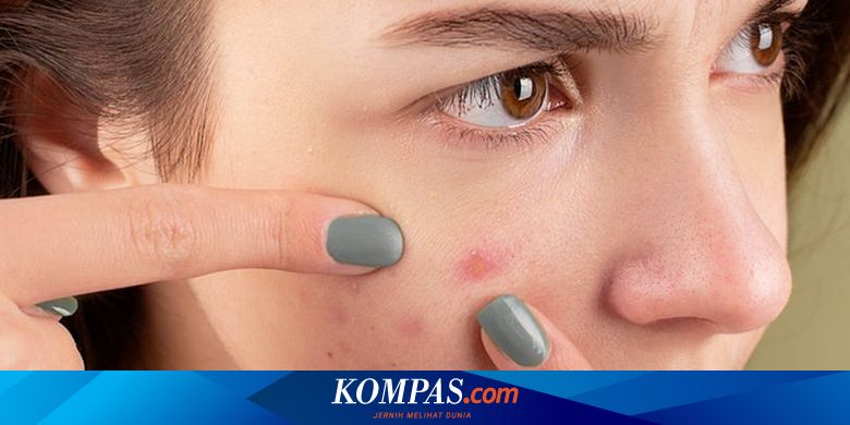 8 Bahan Alami untuk Mengatasi Jerawat Secara Aman