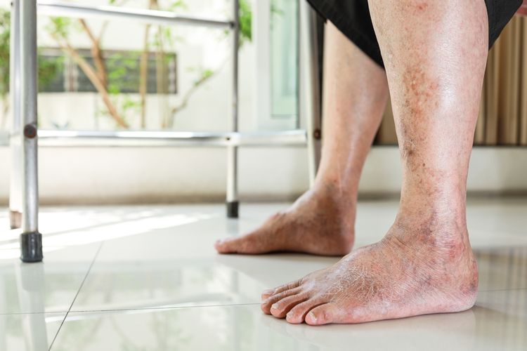 Ilustrasi kaki penderita diabetes. Penderita diabetes dianjurkan melakukan senam kaki diabetes untuk tidak mudah luka. 