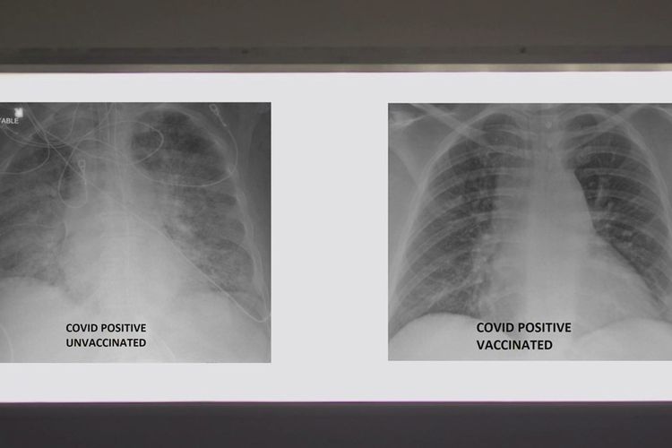 Perbandingan foto rontgen paru-paru pasien Covid-19. Foto pertama dari pasien Covid-19 yang belum divaksin, tertutup area putih. Foto kedua dari pasien yang sudah divaksin, area hitam terlihat.
